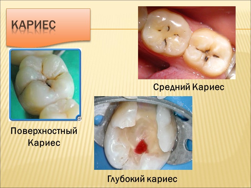 Кариес Поверхностный Кариес Средний Кариес  Глубокий кариес